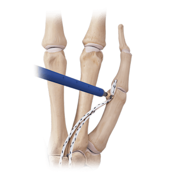 独創的 Arthrex Wrist and Hand - 医学一般